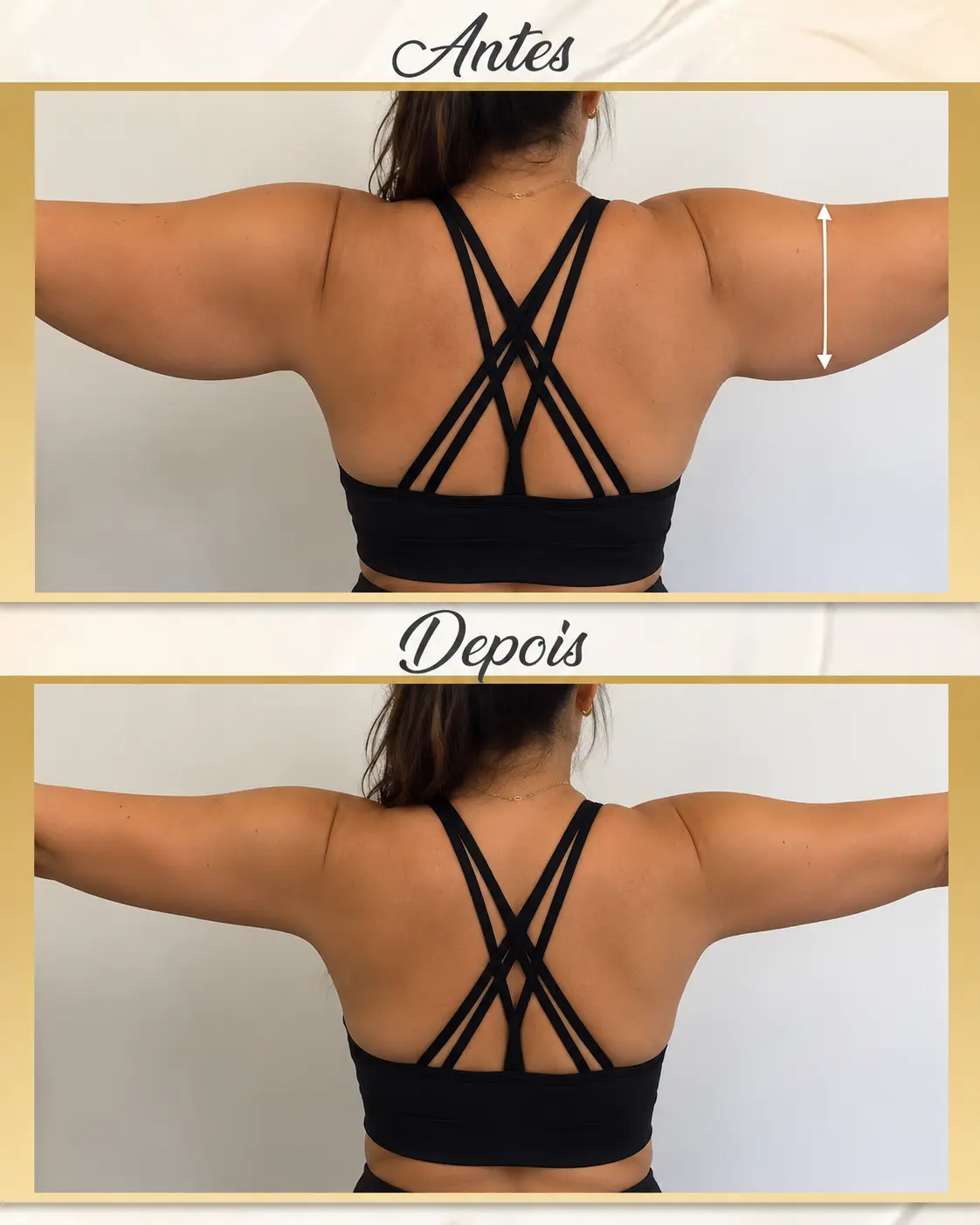 Resultado antes e depois do Truque da Lipo do Braço